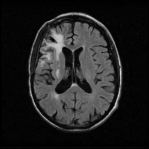 File:Anaplastic meningioma with recurrence (Radiopaedia 34452-35789 Axial FLAIR 14).png