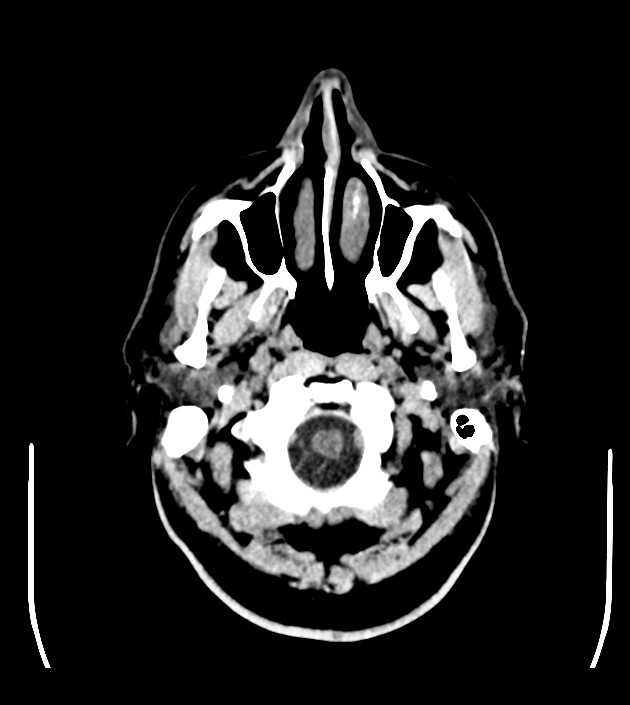 Anaplastic oligodendroglioma (Radiopaedia 79571-92753 Axial non-contrast 7).jpg