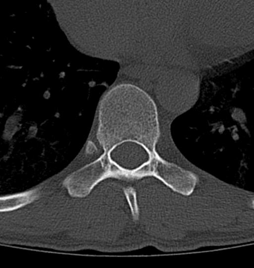 Aneurysmal bone cyst T11 (Radiopaedia 29294-29721 Axial bone window 22).jpg