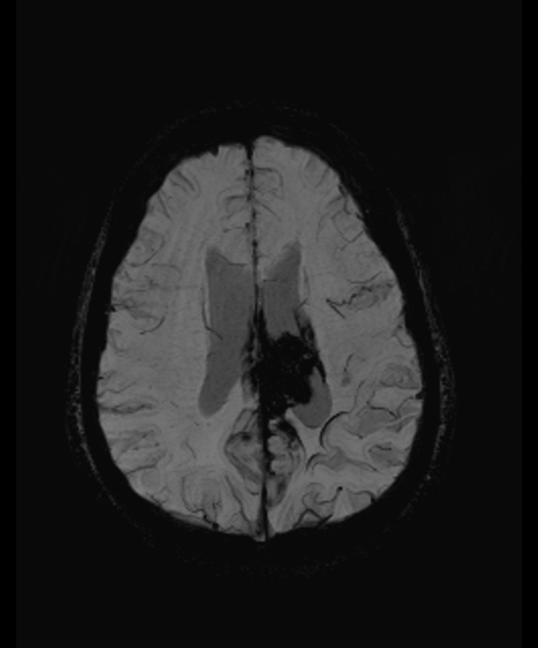 Angiomatous meningioma (Radiopaedia 79459-92579 E 45).jpg