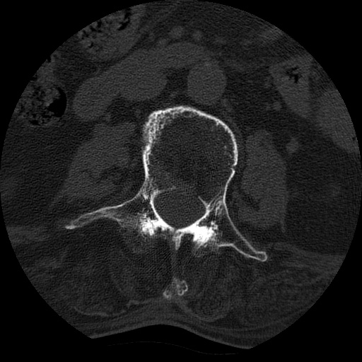 File:Ankylosing spondylitis complicated by fracture-dislocation (Radiopaedia 33583-34674 Axial non-contrast 72).jpg