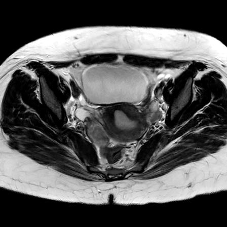 File:Ano-vaginal fistula (Radiopaedia 29765-30284 Axial T2 20).jpg
