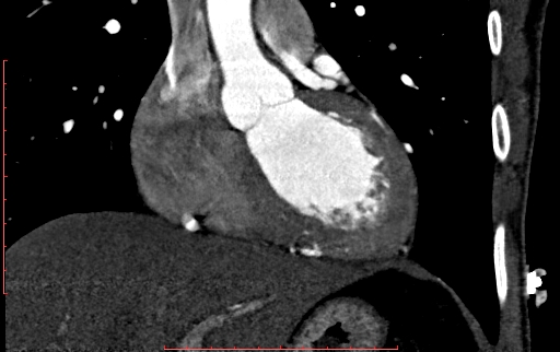Anomalous left coronary artery from the pulmonary artery (ALCAPA) (Radiopaedia 70148-80181 B 136).jpg