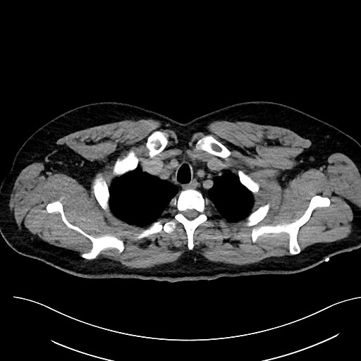 File:Anomalous origin of the left coronary artery with malignant course (Radiopaedia 77842-90126 Axial non-contrast 6).jpeg