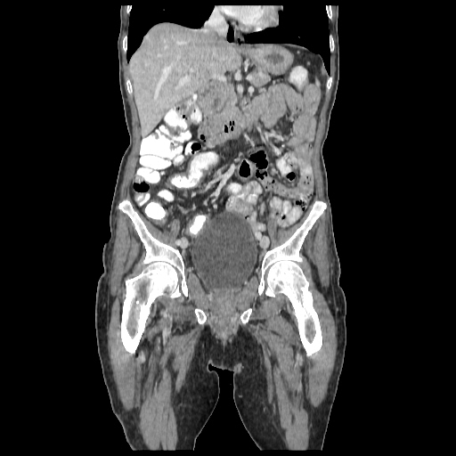 Anorectal carcinoma (Radiopaedia 44413-48064 B 34).jpg