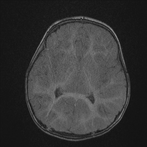 Anoxic brain injury (Radiopaedia 79165-92139 Axial MRA 127).jpg