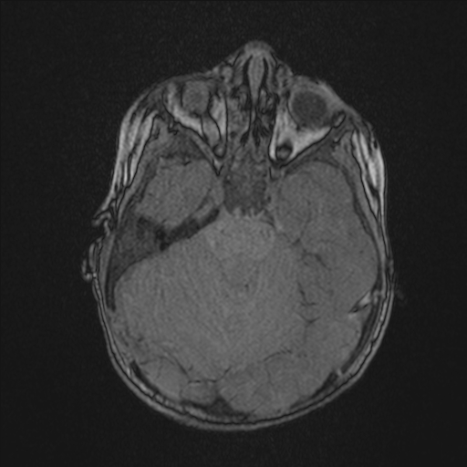 Anoxic brain injury (Radiopaedia 79165-92139 Axial MRA 68).jpg