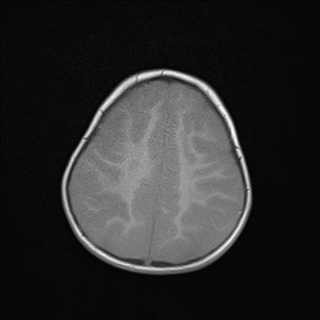 File:Anoxic brain injury (Radiopaedia 79165-92139 Axial T1 21).jpg
