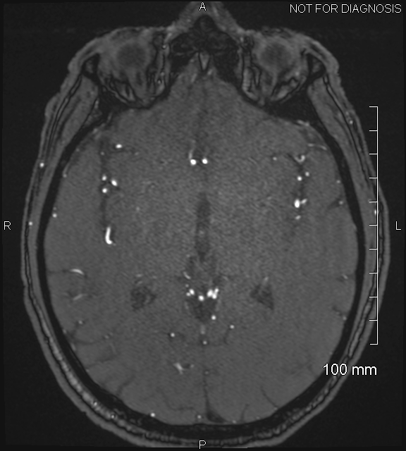 Anterior cerebral artery aneurysm (Radiopaedia 80683-94127 Axial MRA 119).jpg