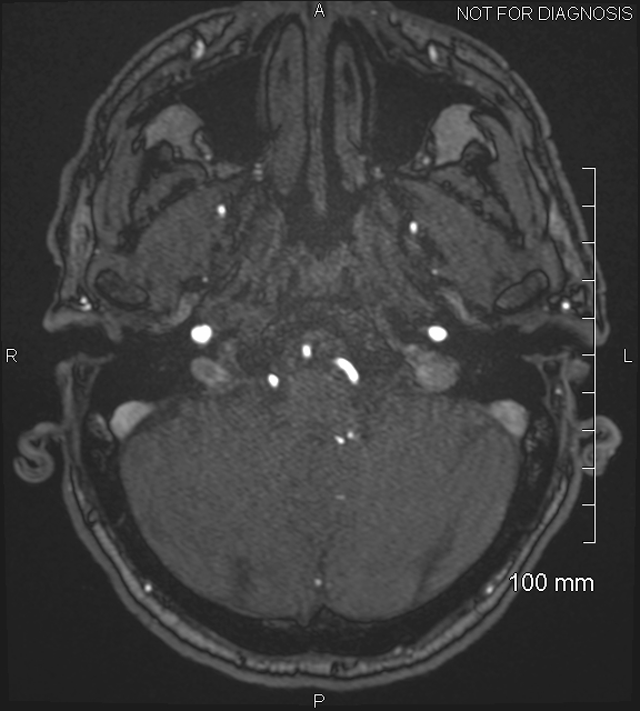 Anterior cerebral artery aneurysm (Radiopaedia 80683-94127 Axial MRA 37).jpg