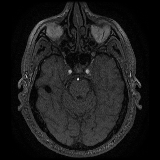 Anterior cerebral artery infarction (Radiopaedia 46794-51323 Axial MRA 49).jpg