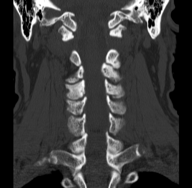 Anterior cervical postdiscectomy arthrodesis (Radiopaedia 32678-33646 Coronal bone window 39).jpg