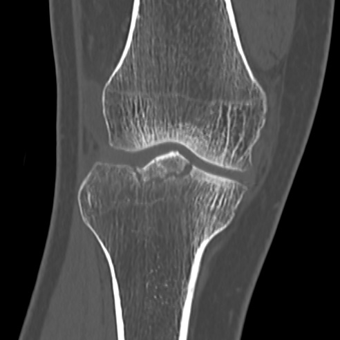 File:Anterior cruciate ligament avulsion fracture (Radiopaedia 58939-66194 Coronal bone window 11).jpg