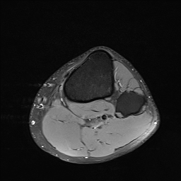 File:Anterior cruciate ligament full thickness tear (Radiopaedia 66268-75467 Axial PD fat sat 28).jpg