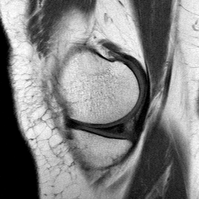 File:Anterior cruciate ligament mucoid degeneration (Radiopaedia 60853-68633 Sagittal T1 38).jpg