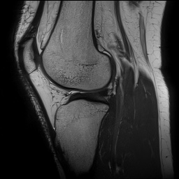 File:Anterior cruciate ligament rupture and posteromedial corner injury (Radiopaedia 67338-76723 Sagittal PD 108).jpg