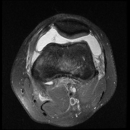 File:Anterior cruciate ligament tear (Radiopaedia 61500-69462 Axial PD fat sat 5).jpg