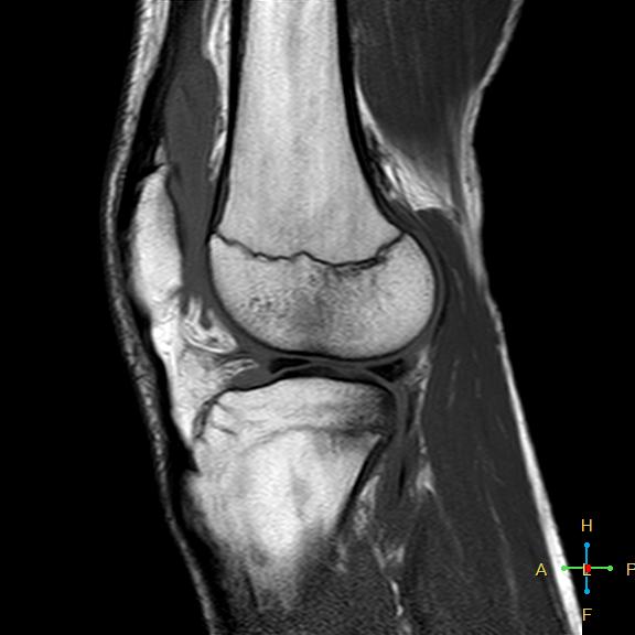 File:Anterior cruciate ligament tear - complete (Radiopaedia 24907-25170 Sagittal T1 5).jpg