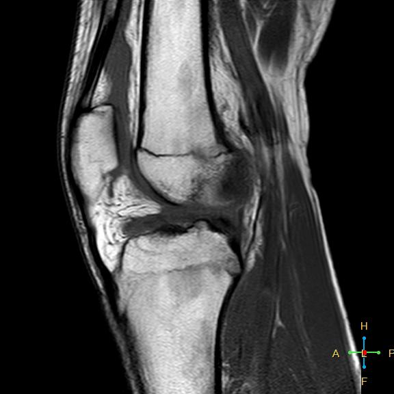 File:Anterior cruciate ligament tear - complete (Radiopaedia 24907-25170 Sagittal T1 8).jpg