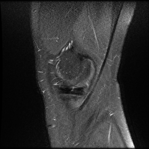 File:Anterior cruciate ligament tear with posteromedial corner injury, bucket-handle meniscal tear and chondral delamination (Radiopaedia 75501-86744 Sagittal PD fat sat 3).jpg