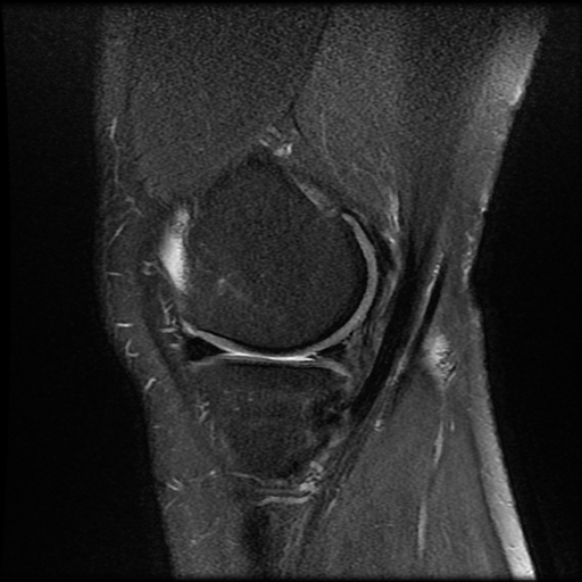 File:Anterior cruciate ligament tear with posteromedial corner injury, bucket-handle meniscal tear and chondral delamination (Radiopaedia 75501-86744 Sagittal PD fat sat 6).jpg