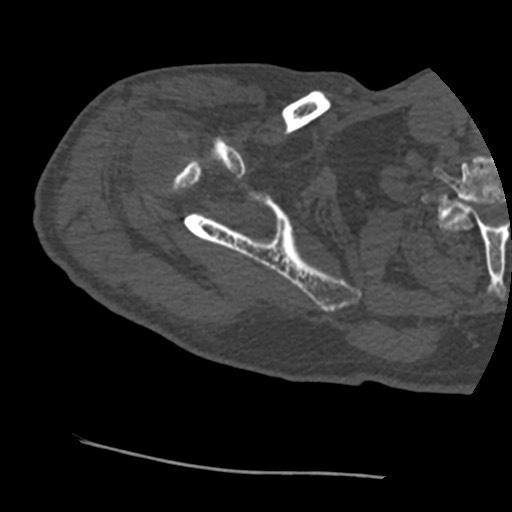 Anterior glenohumeral dislocation with Hill-Sachs lesion (Radiopaedia 62877-71249 Axial bone window 23).jpg