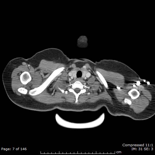 Anterior mediastinal B cell Lymphoma (Radiopaedia 50677-56114 A 4).jpg