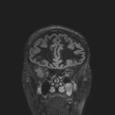 File:Anterior temporal encephalocele (Radiopaedia 82624-96808 Coronal FLAIR 12).jpg