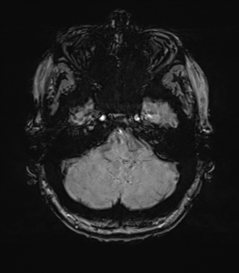Anterior temporal pole cysts (Radiopaedia 46629-51102 Axial SWI 19).png