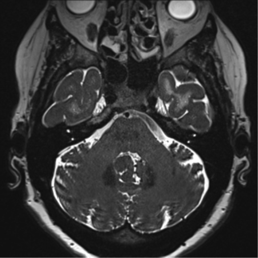 Anterior temporal pole cysts (Radiopaedia 46629-51102 Axial T2 37).png