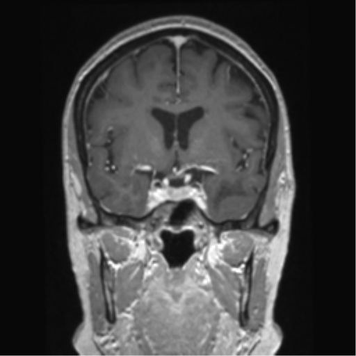 Anterior temporal pole cysts (Radiopaedia 46629-51102 Coronal T1 C+ 106).png