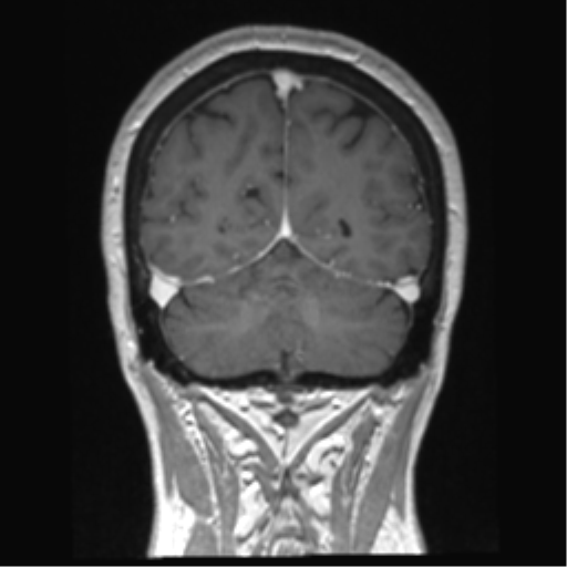 Anterior temporal pole cysts (Radiopaedia 46629-51102 Coronal T1 C+ 43).png