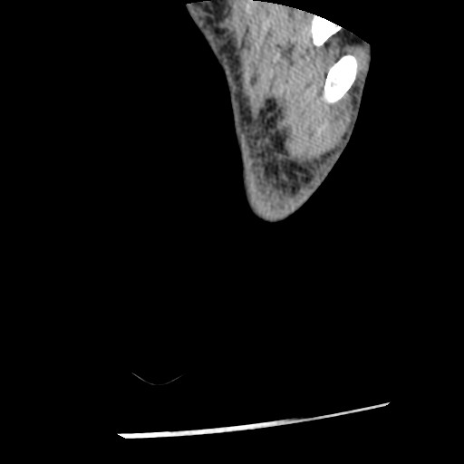 Anterior tibial artery false aneurysm (Radiopaedia 88984-105809 A 265).jpg