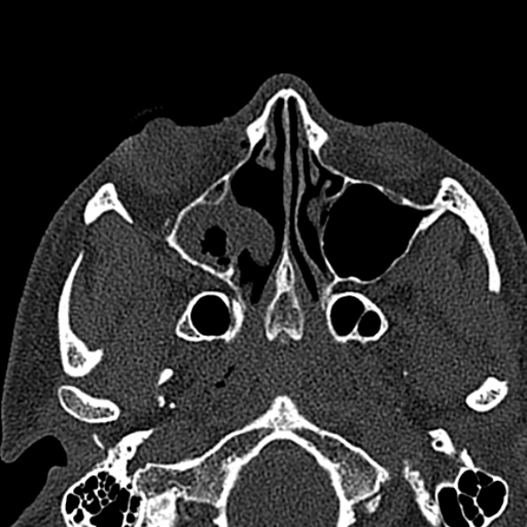 Antrochoanal polyp (Radiopaedia 30002-30554 Axial bone window 30).jpg