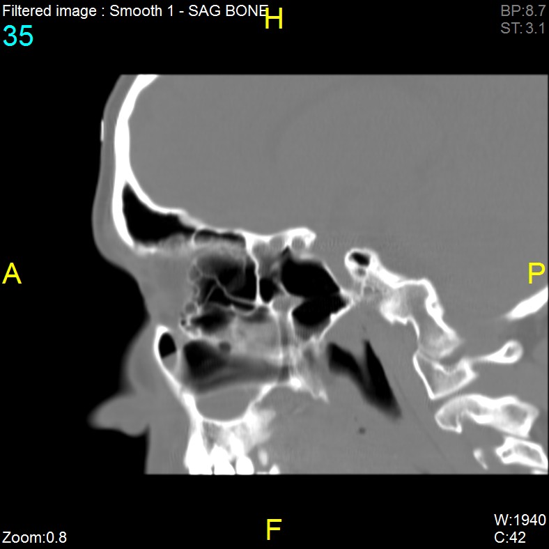 Antrochoanal polyp (Radiopaedia 65101-74094 Sagittal bone window 35).jpg