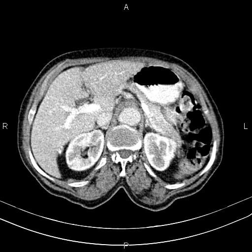 File:Aortic aneurysm and Lemmel syndrome (Radiopaedia 86499-102554 A 26).jpg