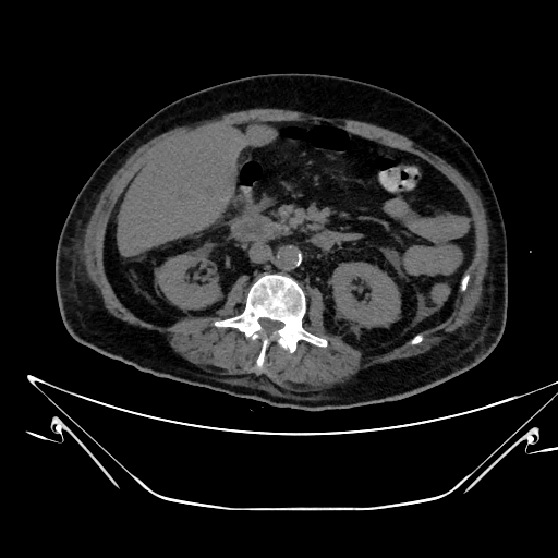 Aortic arch aneurysm (Radiopaedia 84109-99365 Axial non-contrast 346).jpg