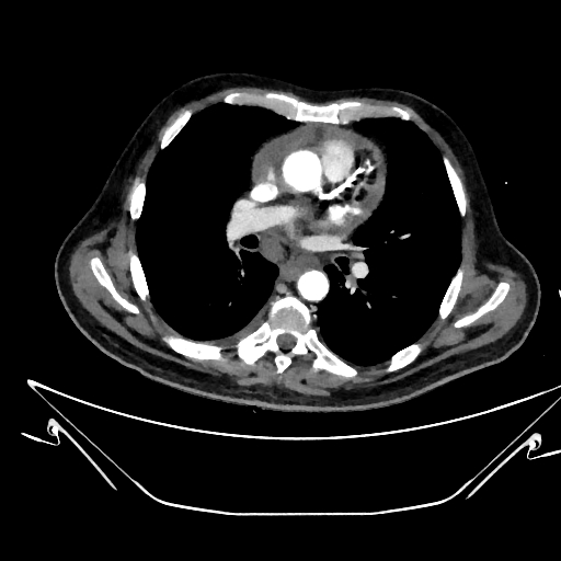 Aortic arch aneurysm (Radiopaedia 84109-99365 C 217).jpg