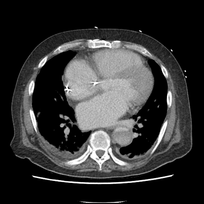 Aortic arch graft infection (FDG PET-CT) (Radiopaedia 71975-82437 A 36).jpg