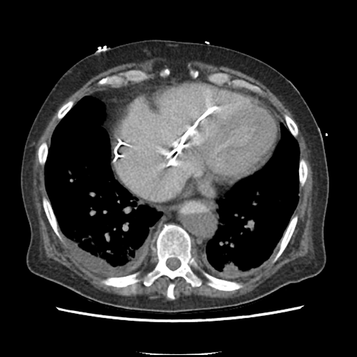 Aortic arch graft infection (FDG PET-CT) (Radiopaedia 71975-82437 A 44).jpg