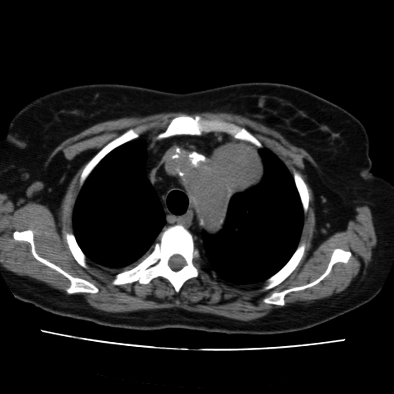 Aortic arch pseudoaneurysm (Radiopaedia 8534-9368 Axial non-contrast 16).jpg
