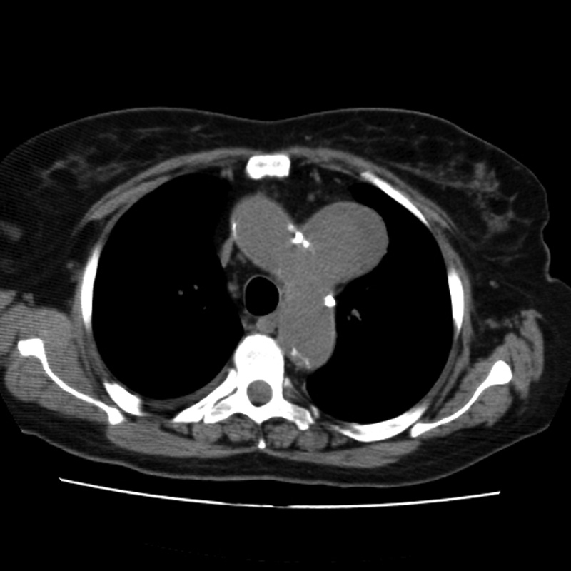 Aortic arch pseudoaneurysm (Radiopaedia 8534-9368 Axial non-contrast 22).jpg