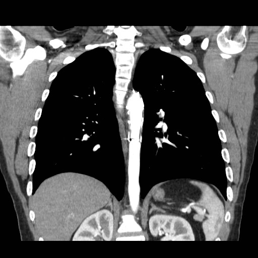 File:Aortic arch stent (Radiopaedia 30030-30595 F 22).jpg
