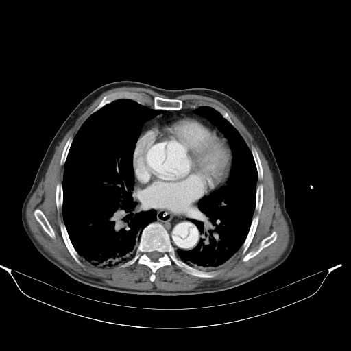 Aortic dissection- Stanford type A (Radiopaedia 22085-22085 A 25).jpg