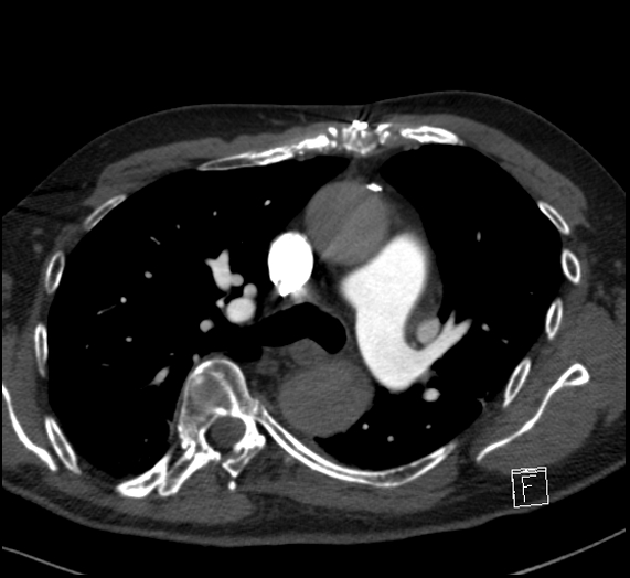 File:Aortic dissection (CTPA) (Radiopaedia 75506-86751 Axial C+ CTPA 58).jpg
