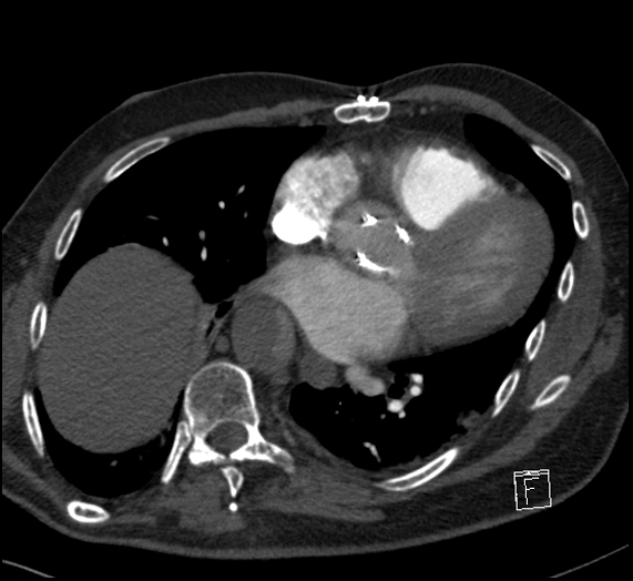 File:Aortic dissection (CTPA) (Radiopaedia 75506-86751 Axial C+ CTPA 86).jpg