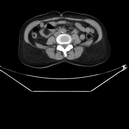 Aortic dissection (Radiopaedia 25350-25604 B 55).jpg