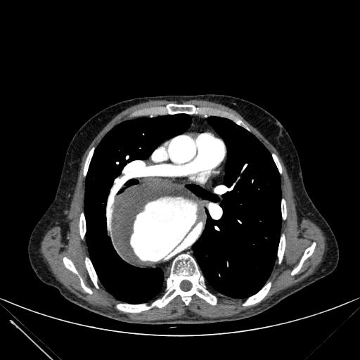 Aortic dissection (Radiopaedia 27466-27665 C+ arterial phase 120).jpg