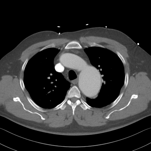 Aortic dissection (Radiopaedia 50763-56234 A 15).png