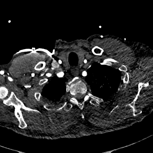 File:Aortic dissection - DeBakey type II (Radiopaedia 64302-73082 A 11).png
